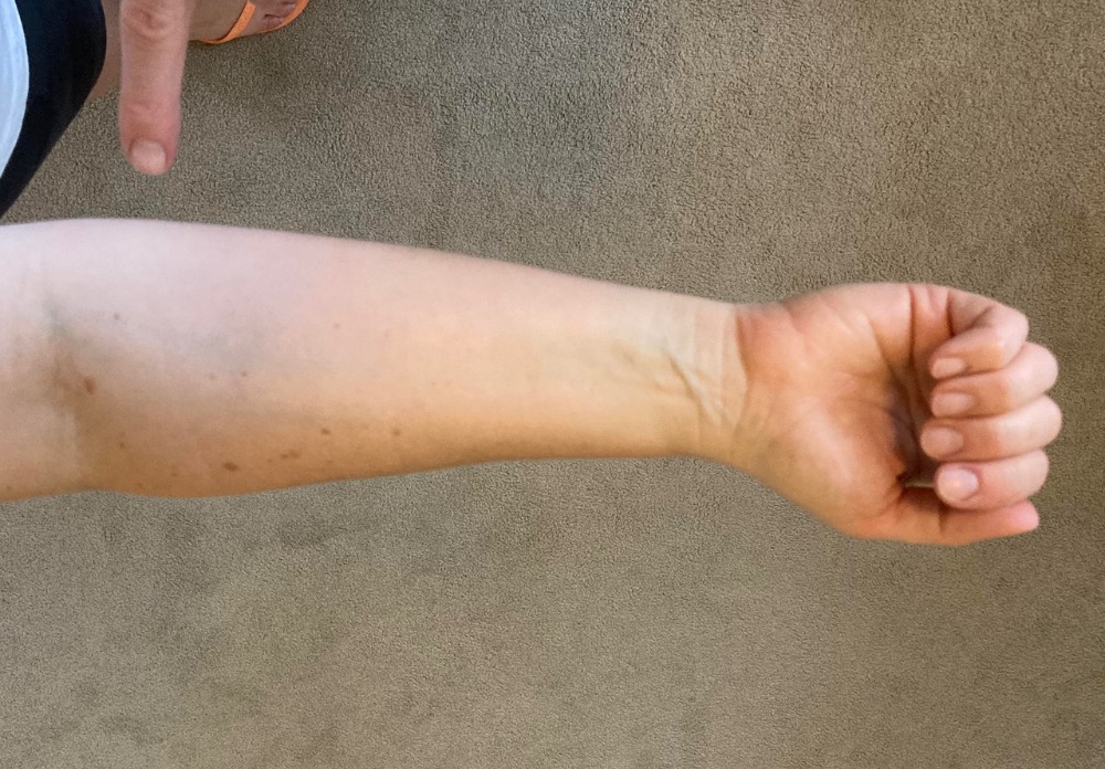 Finger flexor (curling) muscles start here